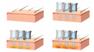 毛穴の汚れを除去、色調改善、若返り美肌治療