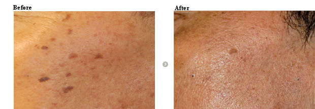 くすみ肌・表在性シミ