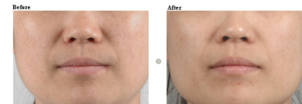 透明肌・引締め