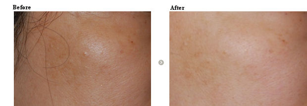 色調改善・肌質改善