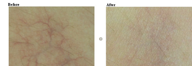 毛細血管拡張症