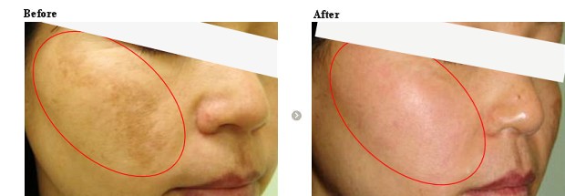 肝斑治療 ルートロトーニング