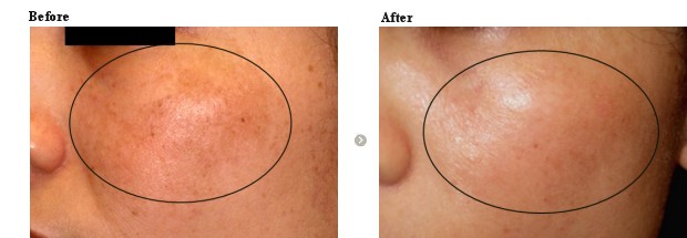 肝斑治療 ルートロトーニング