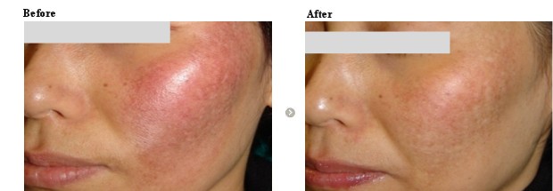 色素沈着治癒促進 ルートロトーニング