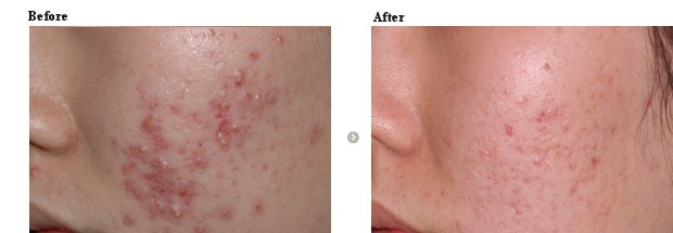 ニキビ治療、肌質改善