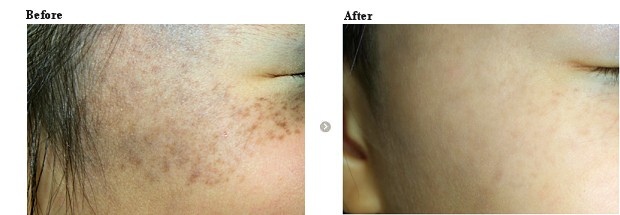 太田母斑治療と美白