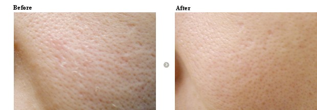 毛穴縮小と引締め