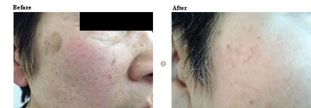 シミ(表在性の色素斑）治療